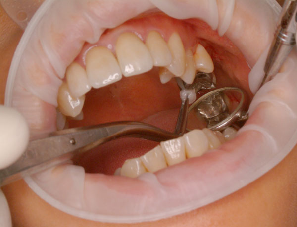 Polerowanie zębów